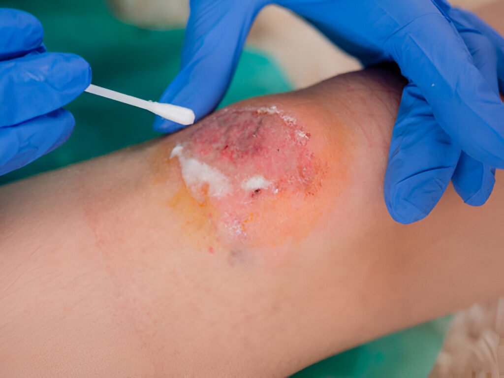 Cellulitis wounds care clinic il