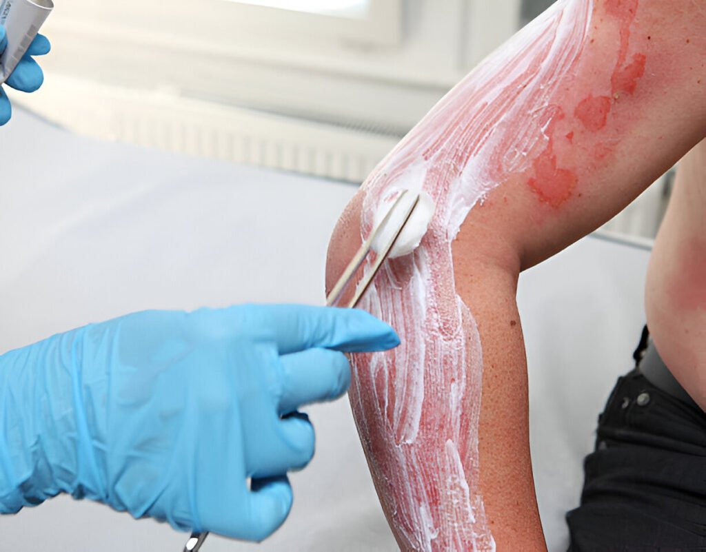 burned wound care clinic at Illinois